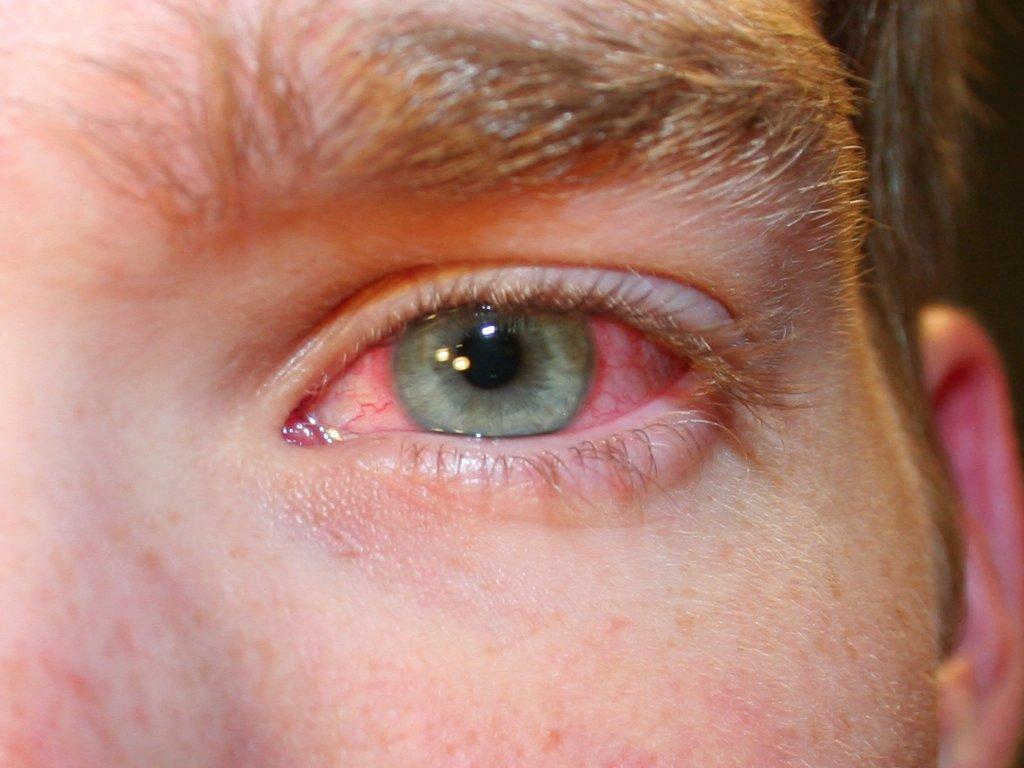 Image result for kesan buruk contact lens